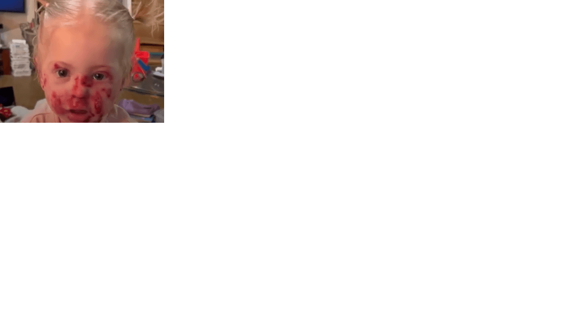 Aos 4 anos, Agatha vive com Epidermolise Bolhosa e tem o corpo todo coberto por feridas que doem ao toque