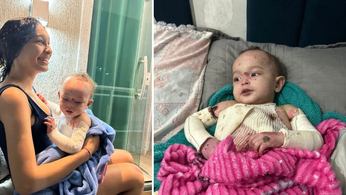 Bebe nasceu com parte do corpo sem pele e a mae de 17 anos luta sozinha pra mante-lo vivo fora do hospital